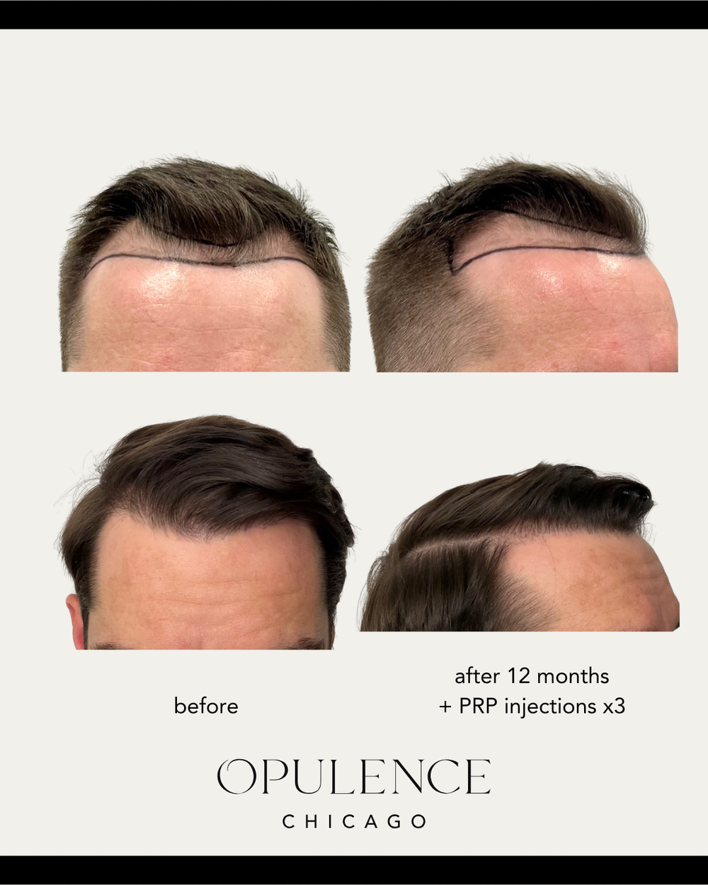 FUE hair restoration before and after — 12 months