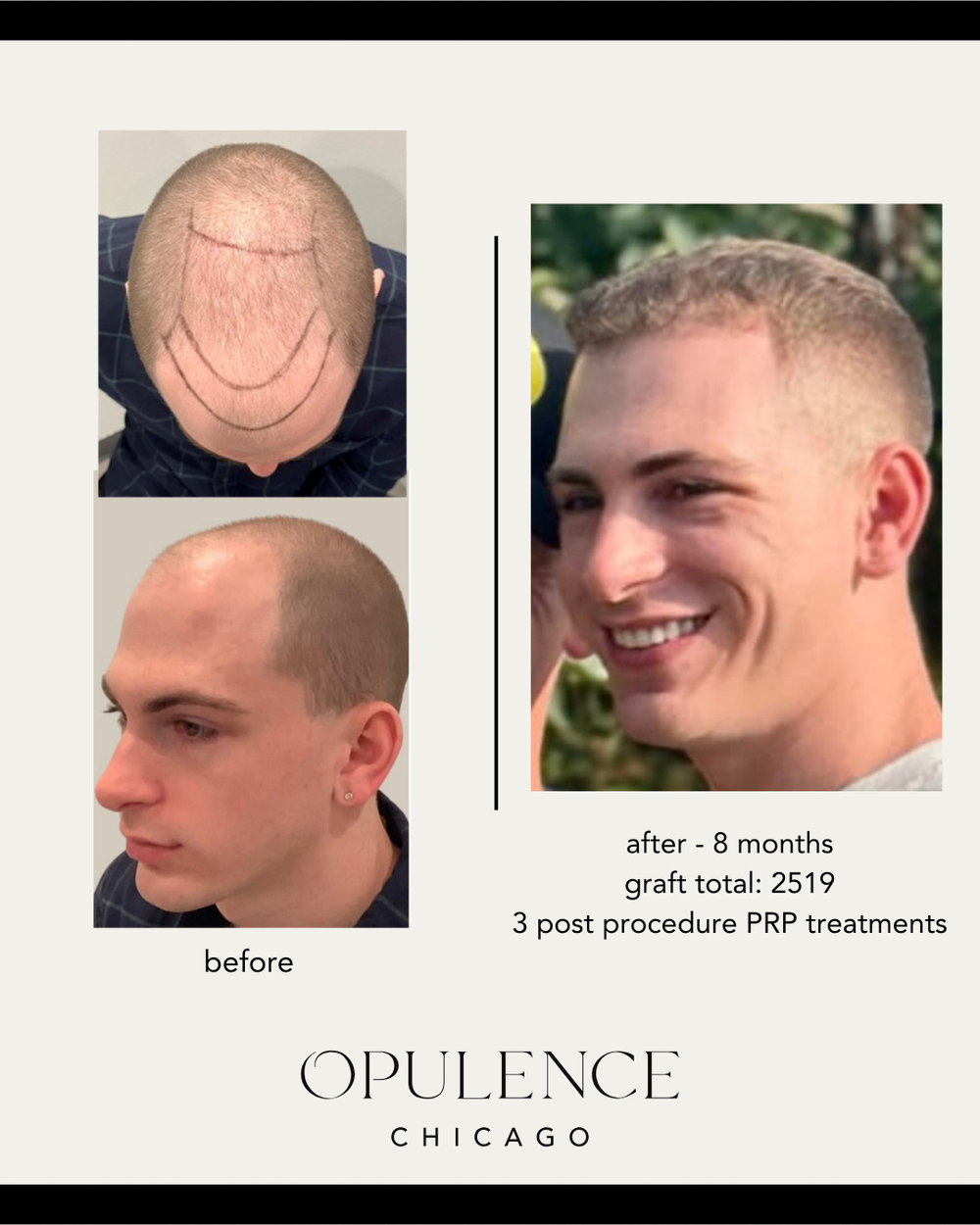 2500 graft FUE hair restoration result